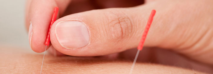 Unlock the Healing Power of Acupuncture in Downtown San Diego CA